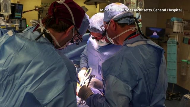 Pig kidney transplant not linked to man's death, doctors say