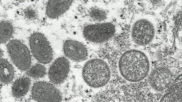 WHO warns monkeypox outbreak 'tip of the iceberg'