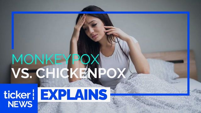 The difference between chickenpox and monkeypox